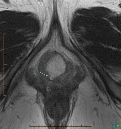 inflammation glande de skene|Skene’s gland revisited: function, dysfunction and the G spot